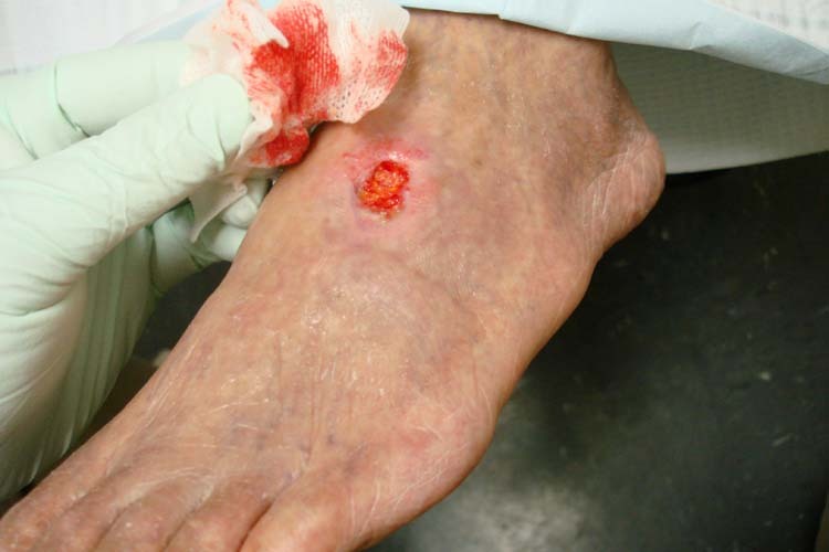 woundcare-Image015